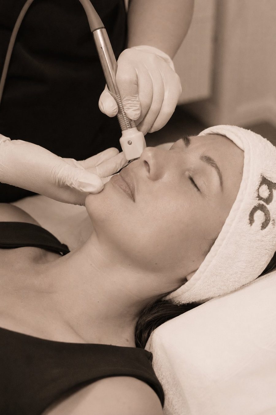 Fractora RF microneedling treatment