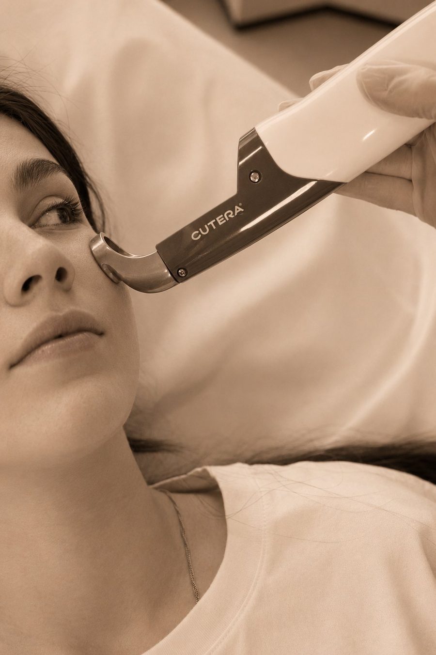 Cutera Excel V vascular laser treatment