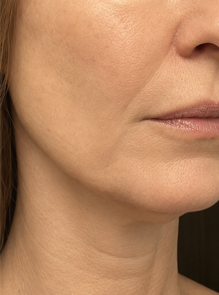 Age-related skin after