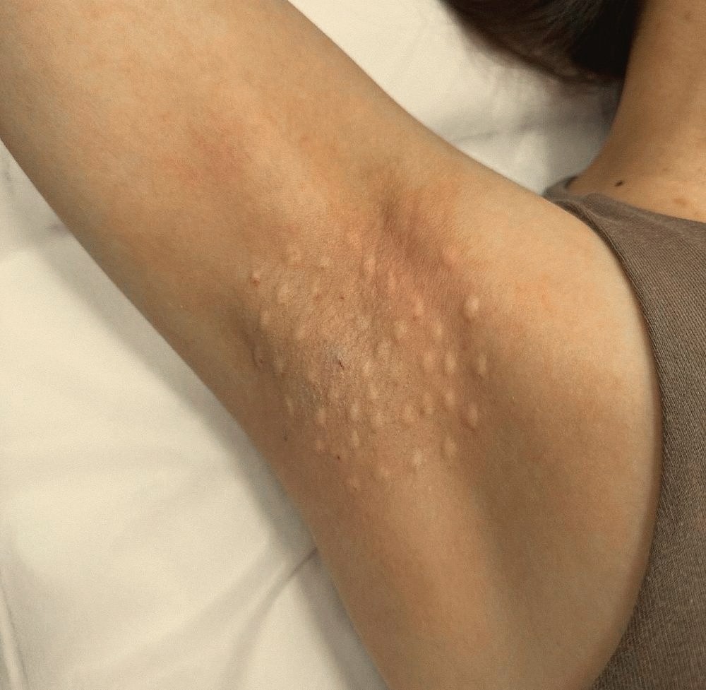 Hyperhidrosis after