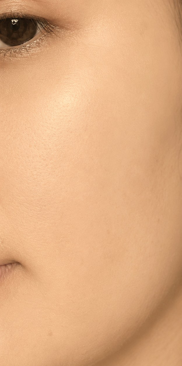 Oily skin & acne after