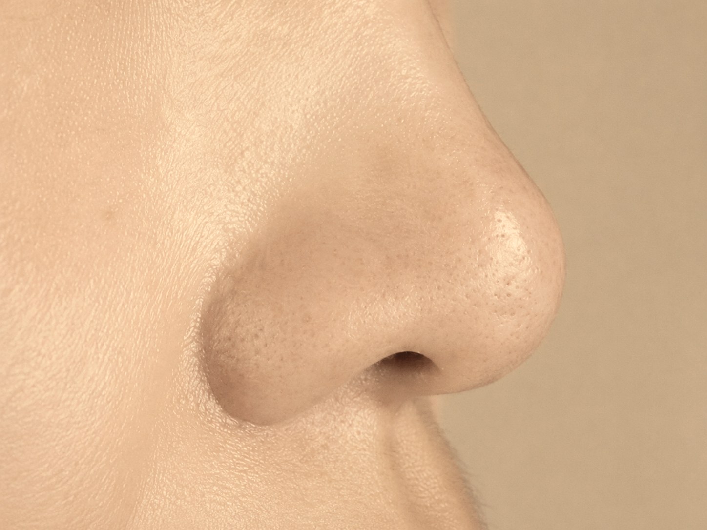 Enlarged pores after