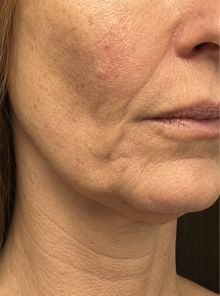Age-related skin before