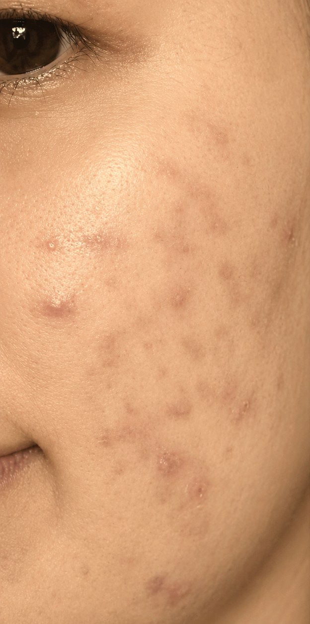 Oily skin & acne before